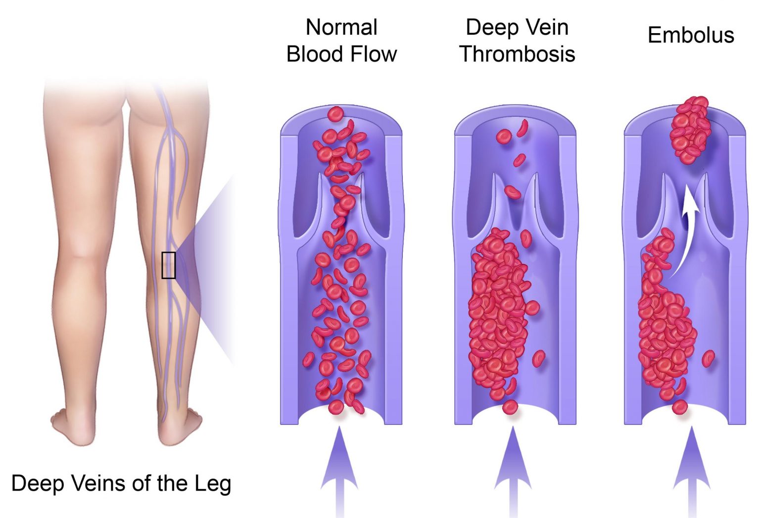 Dvt Symptoms Treatment St George Ut Deep Vein Thrombosis Condition