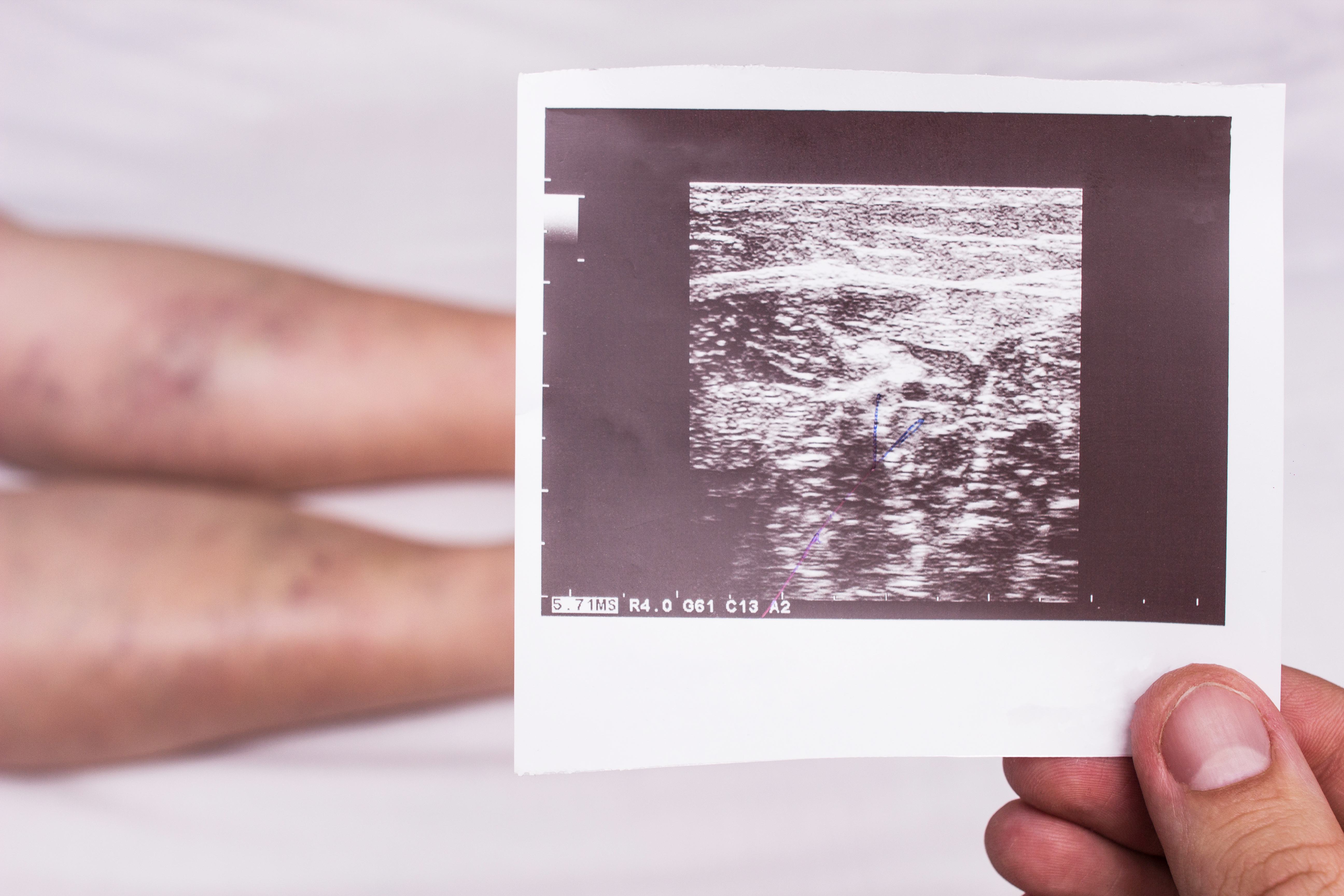 Vascular doctor holds ultrasound picture showing deep vein thrombosis in elderly woman patient's legs
