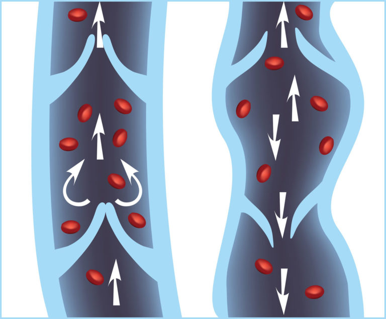 Chronic Venous Insufficiency: Don't Ignore the Symptoms