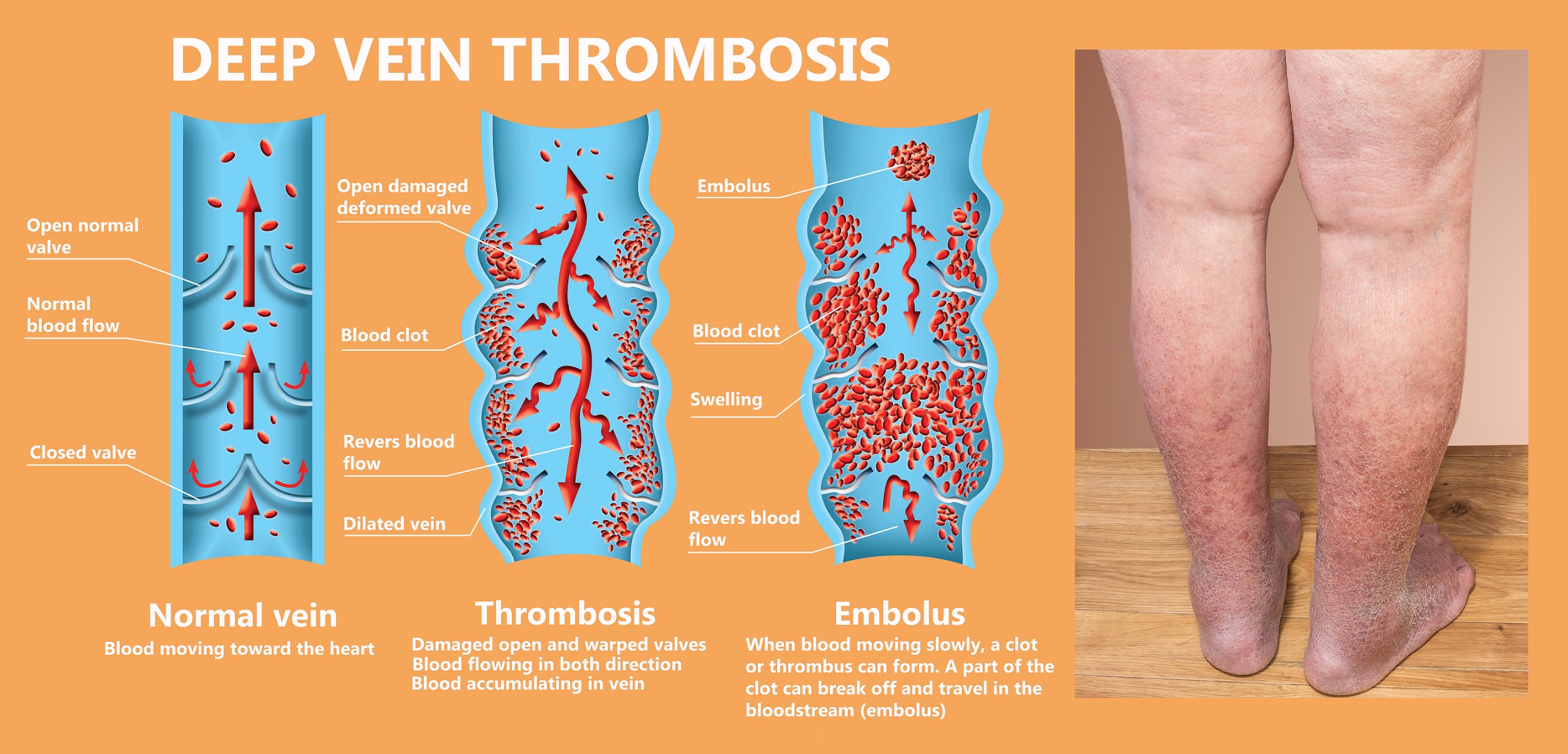 DVT, What is Deep Vein Thrombosis + Is It Dangerous?