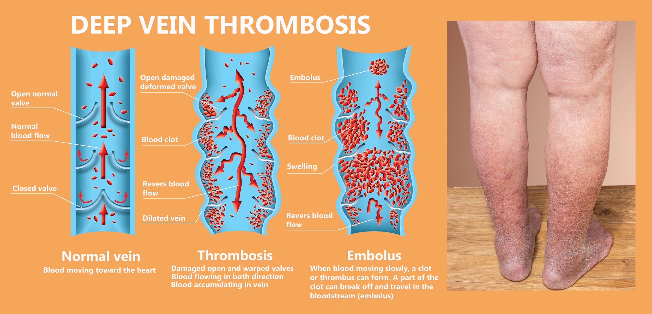 When Blood Clots And Dvt Become Dangerous To Your Health Dvt Treatment