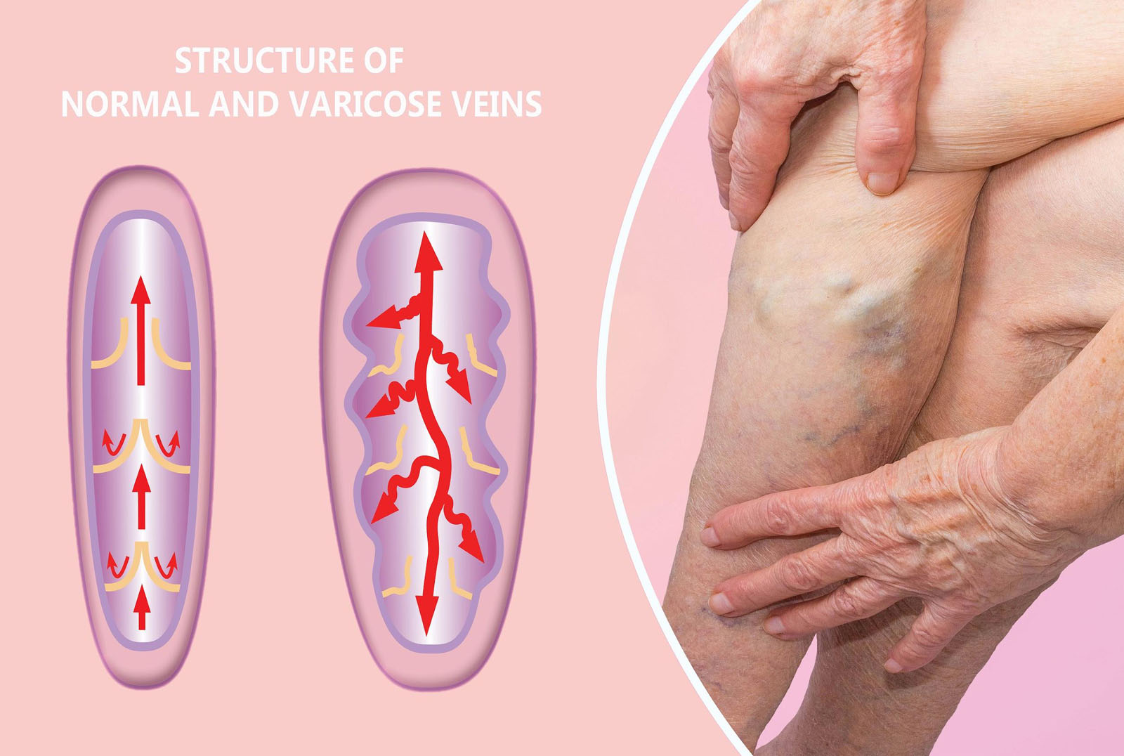 Itchy varicose veins - Enhanceskin