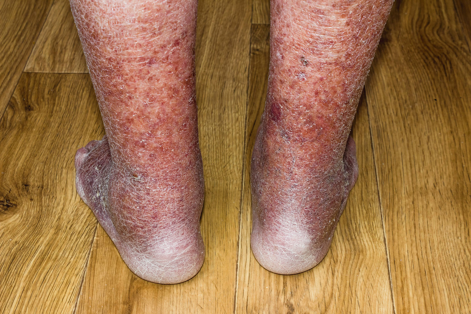 Why Early Evaluation Helps You To Avoid Serious Varicose Vein Risks