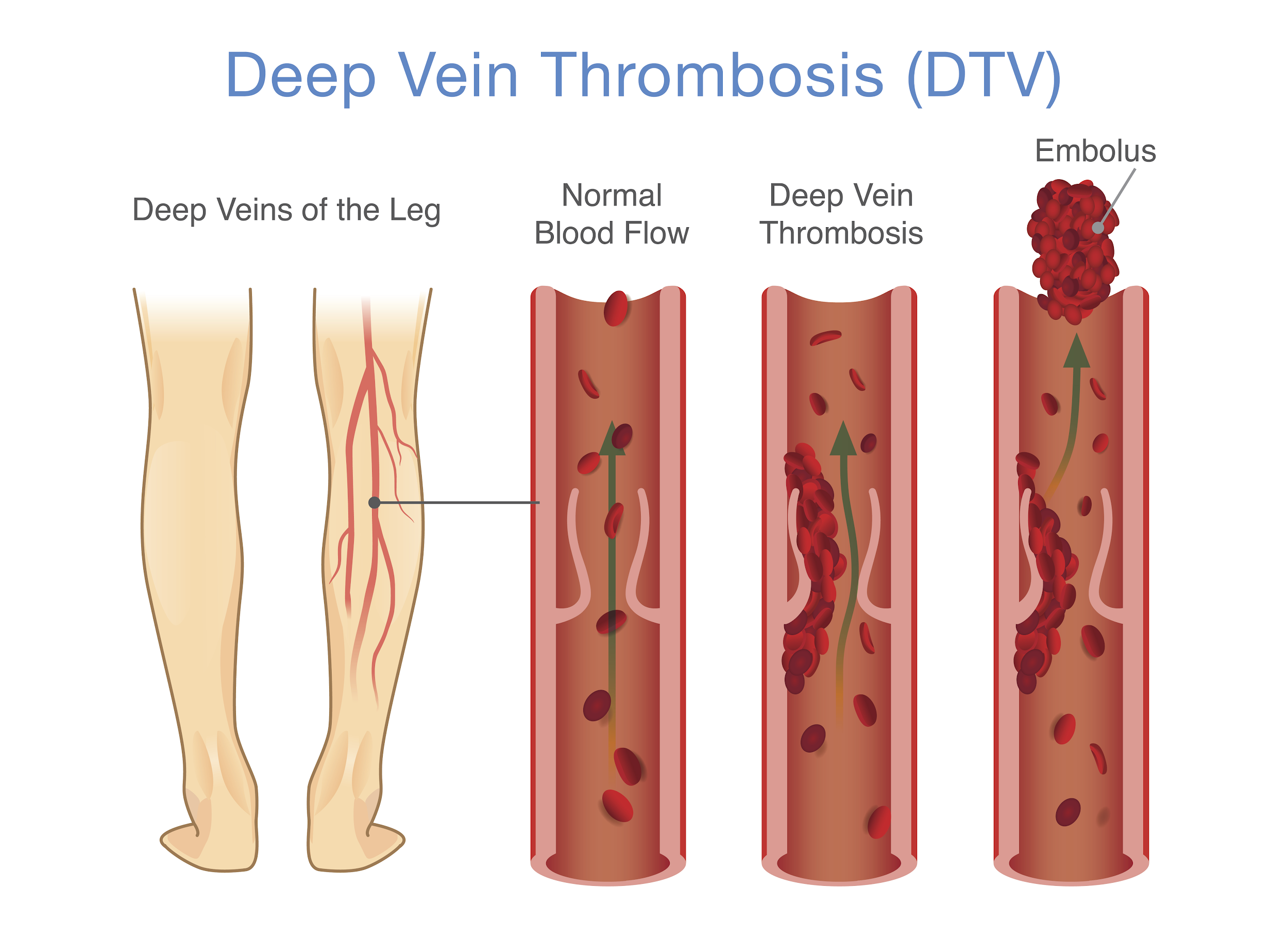 presentation of dvt