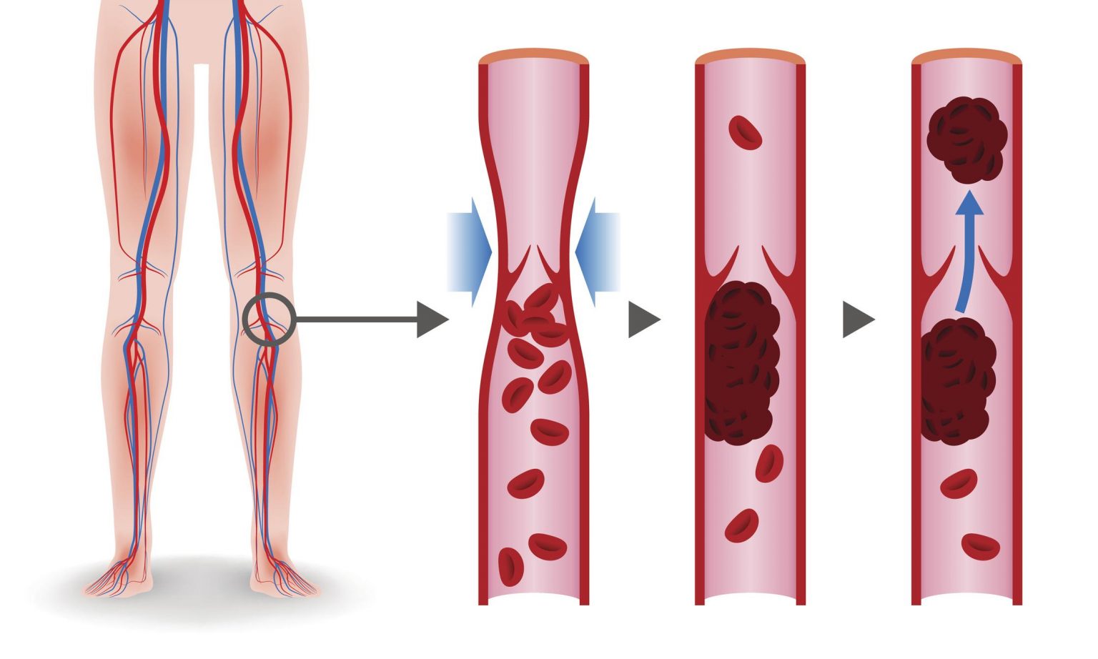 Superficial Vein Thrombosis  Complications of Varicose Veins