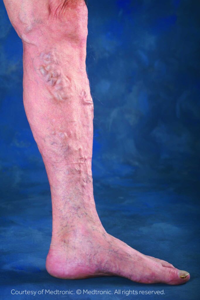 Varicose Veins: Symptoms, Risk Factors, Treatment