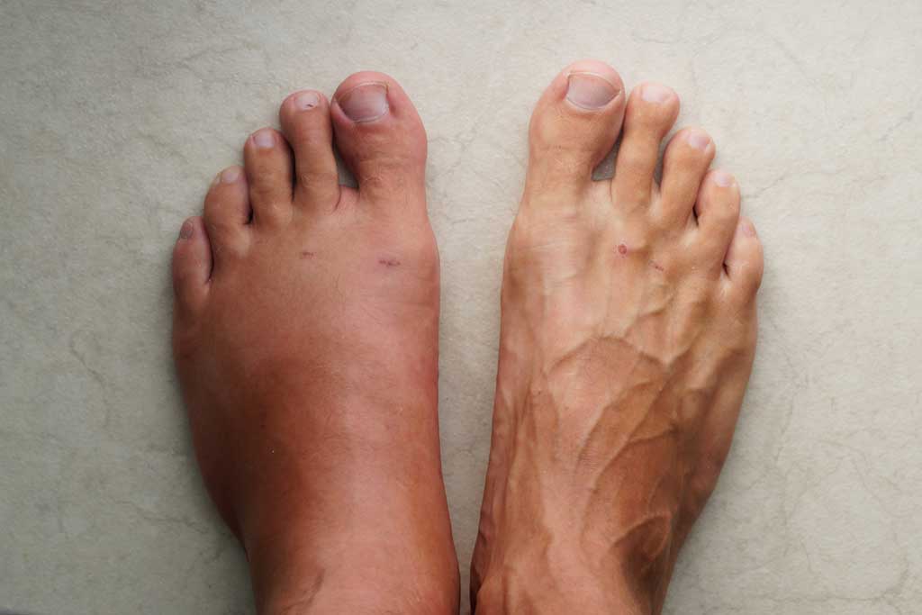 The Connection Between Vein Damage and Leg Swelling