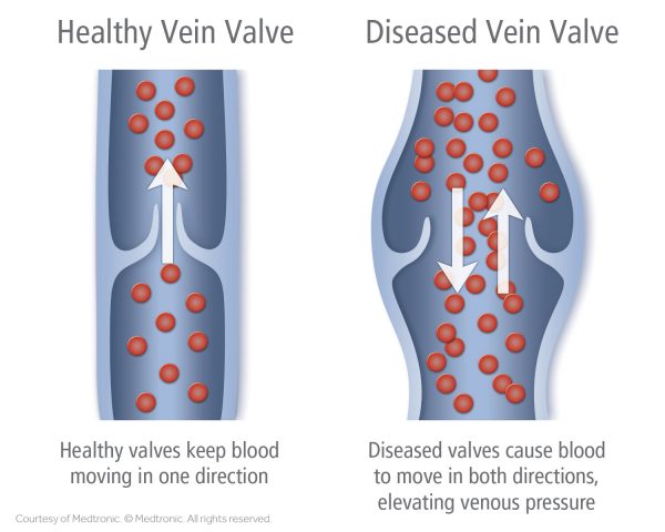 Venous Insufficiency, Venous Reflux